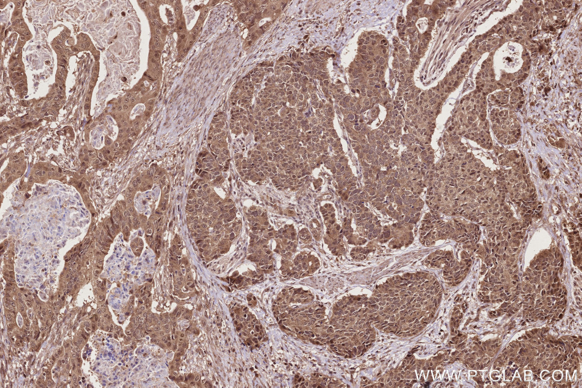 Immunohistochemical analysis of paraffin-embedded human stomach cancer tissue slide using KHC2773 (RNF34 IHC Kit).