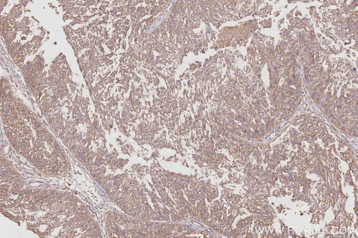 Immunohistochemical analysis of paraffin-embedded human ovary cancer tissue slide using KHC2998 (RNF7 IHC Kit). Immunohistochemical analysis of paraffin-embedded human ovary cancer tissue slide using KHC2998 (RNF7 IHC Kit).