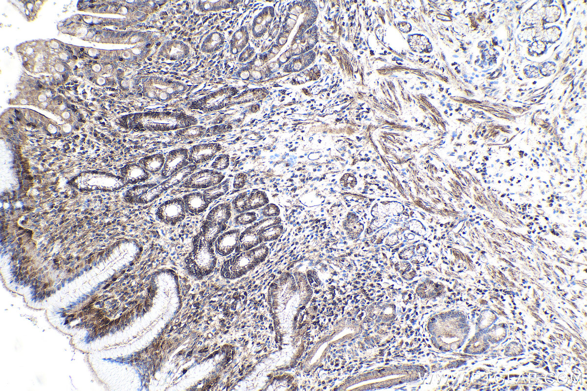 Immunohistochemical analysis of paraffin-embedded human stomach cancer tissue slide using KHC1917 (ROGDI IHC Kit).