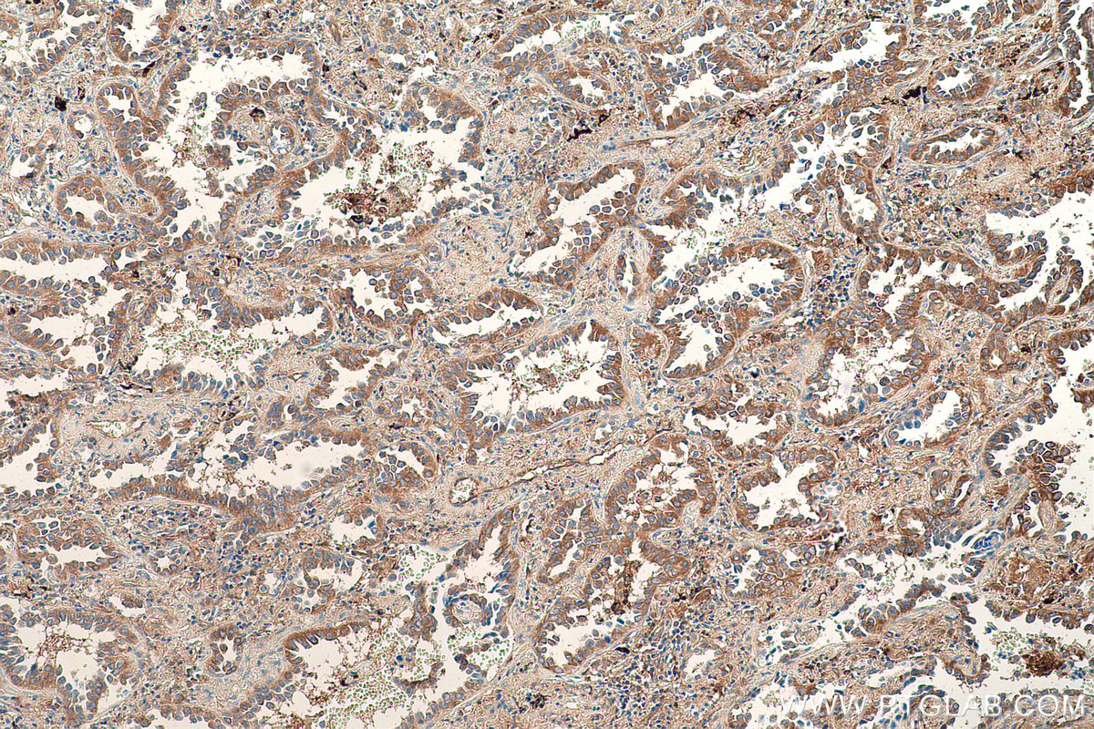 Immunohistochemical analysis of paraffin-embedded human lung cancer tissue slide using KHC0819 (ROR1 IHC Kit).