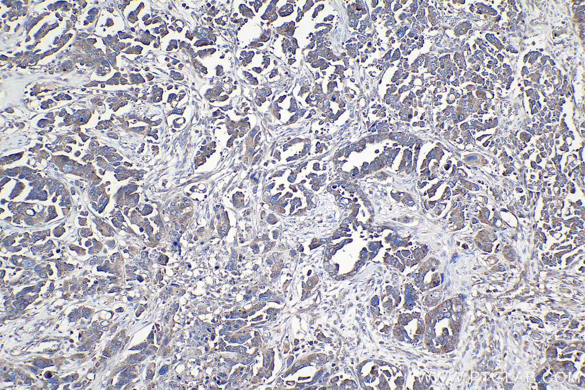 Immunohistochemical analysis of paraffin-embedded human colon cancer tissue slide using KHC0997 (RPAP3 IHC Kit).