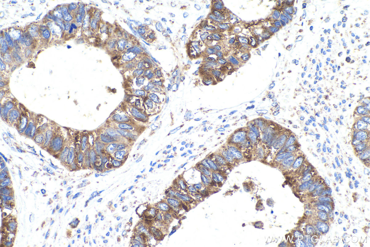 Immunohistochemical analysis of paraffin-embedded human urothelial carcinoma tissue slide using KHC0914 (RPL21 IHC Kit).