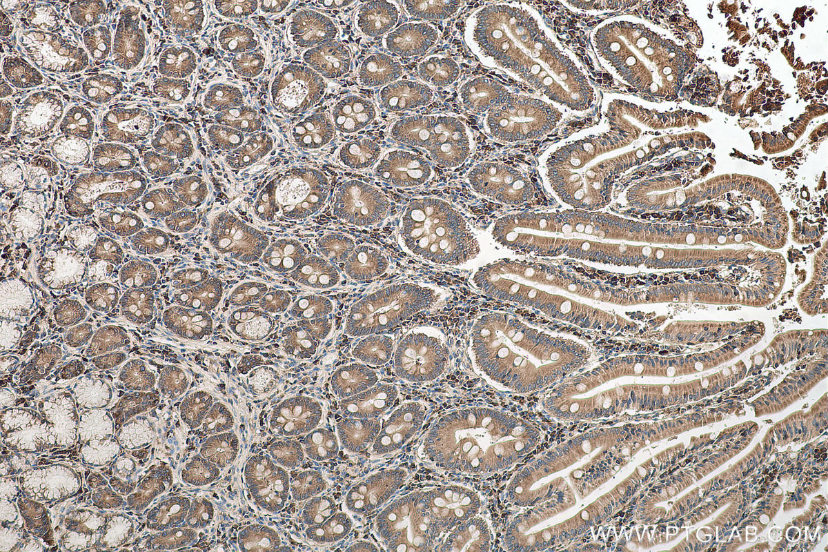 Immunohistochemical analysis of paraffin-embedded human stomach cancer tissue slide using KHC0639 (RPL23 IHC Kit).
