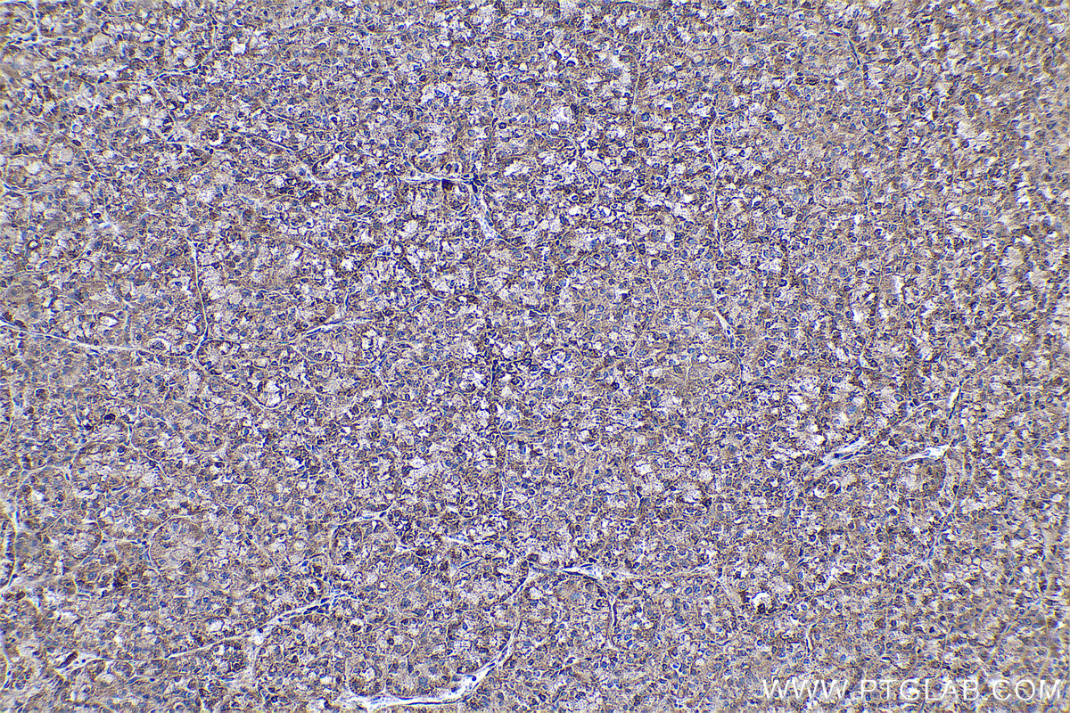 Immunohistochemical analysis of paraffin-embedded human liver cancer tissue slide using KHC0583 (RPL23A IHC Kit).
