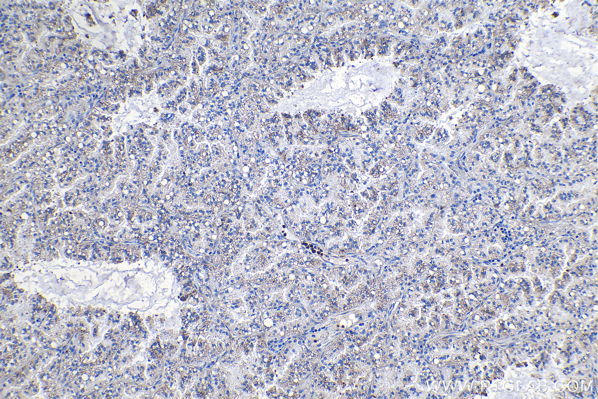 Immunohistochemical analysis of paraffin-embedded human lung cancer tissue slide using KHC1144 (RPL31 IHC Kit).