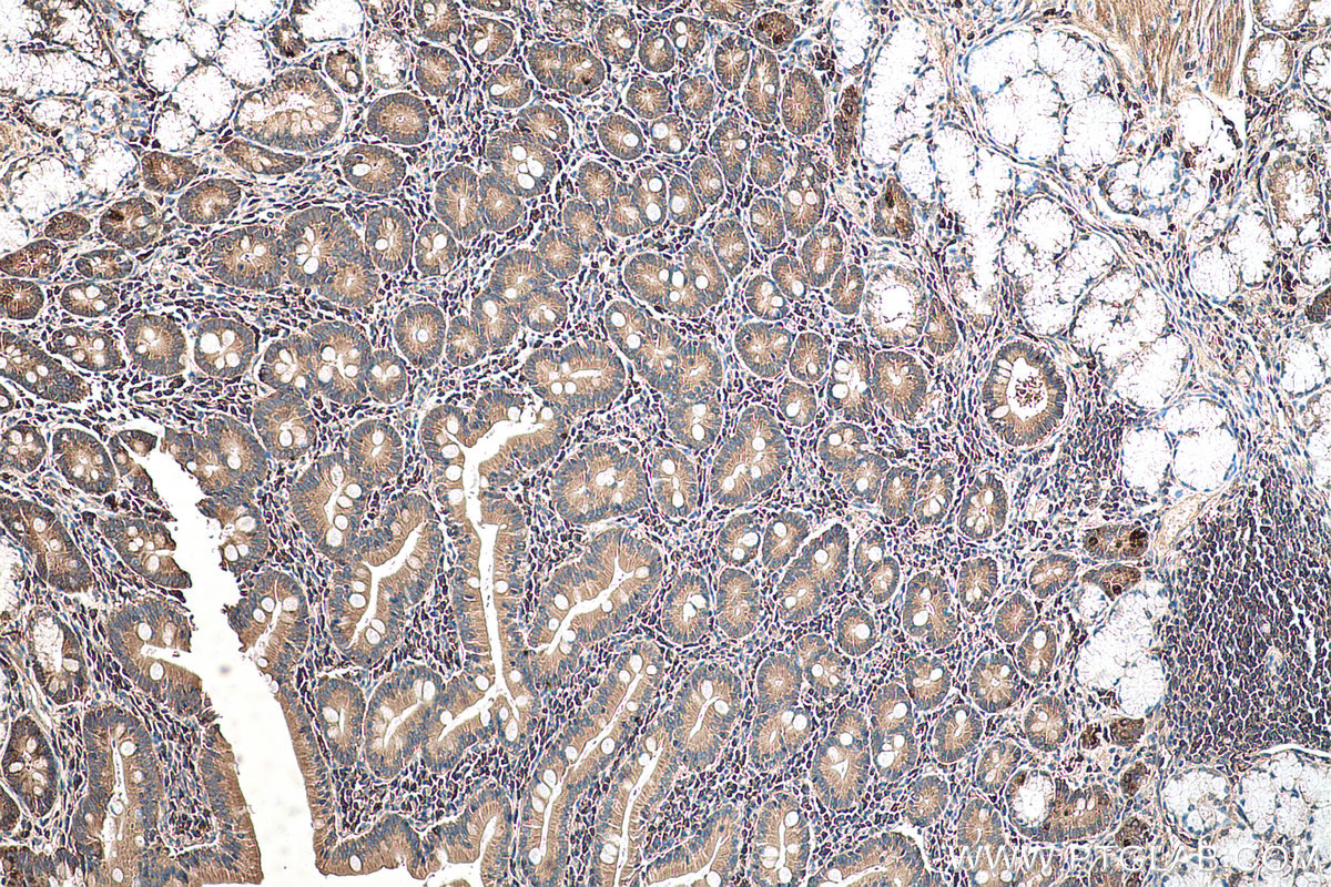 Immunohistochemical analysis of paraffin-embedded human stomach cancer tissue slide using KHC0586 (RPL35 IHC Kit).
