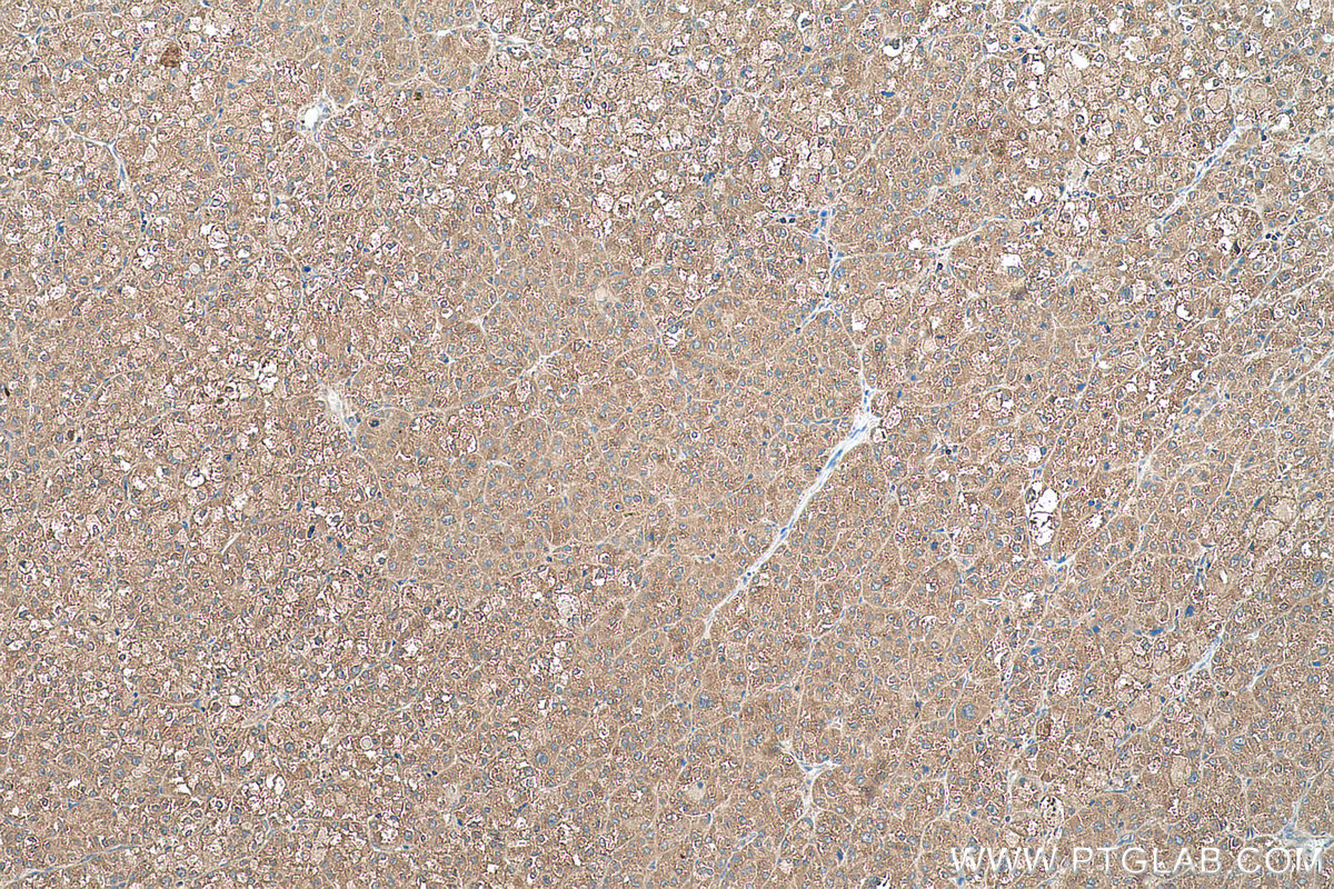 Immunohistochemical analysis of paraffin-embedded human liver cancer tissue slide using KHC0586 (RPL35 IHC Kit).