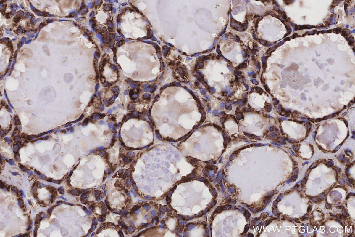 Immunohistochemical analysis of paraffin-embedded human thyroid cancer tissue slide using KHC3212 (RPL5 IHC Kit).