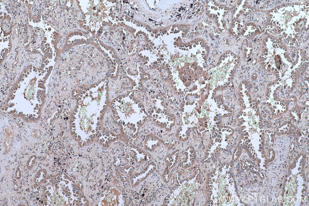 Immunohistochemical analysis of paraffin-embedded human lung cancer tissue slide using KHC0640 (RPL6 IHC Kit).