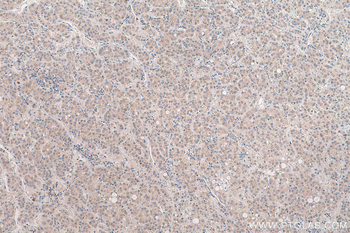 Immunohistochemical analysis of paraffin-embedded human liver cancer tissue slide using KHC0640 (RPL6 IHC Kit).