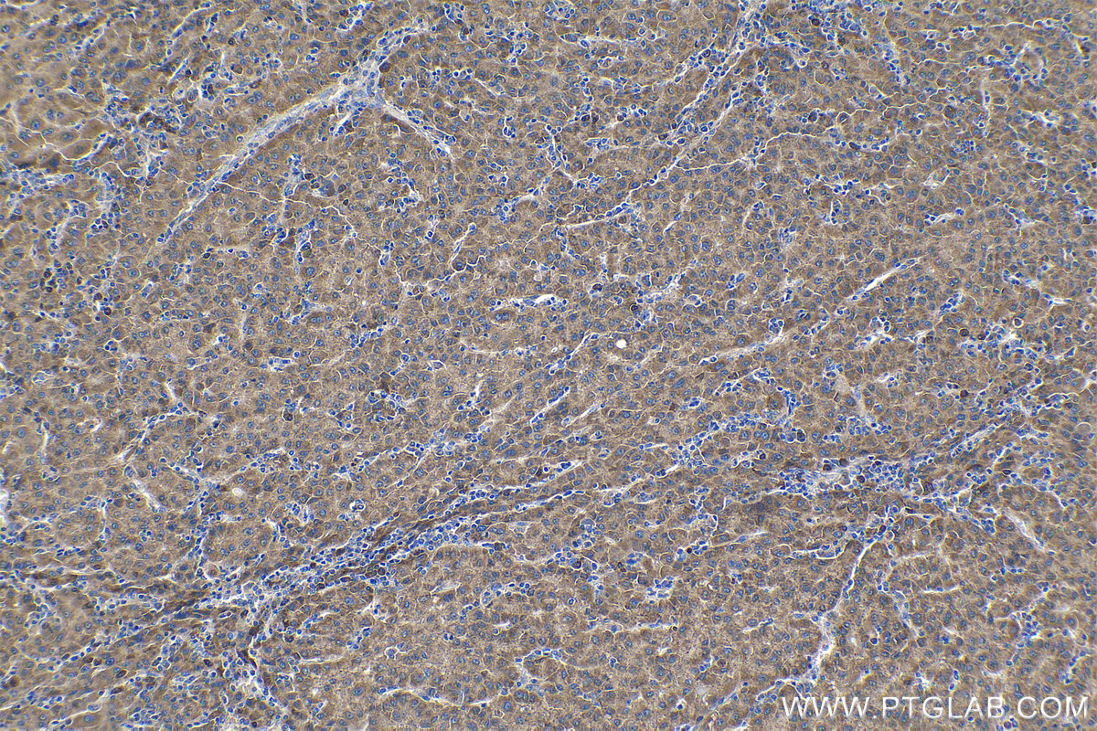 Immunohistochemical analysis of paraffin-embedded human liver cancer tissue slide using KHC1265 (RPL7A IHC Kit).