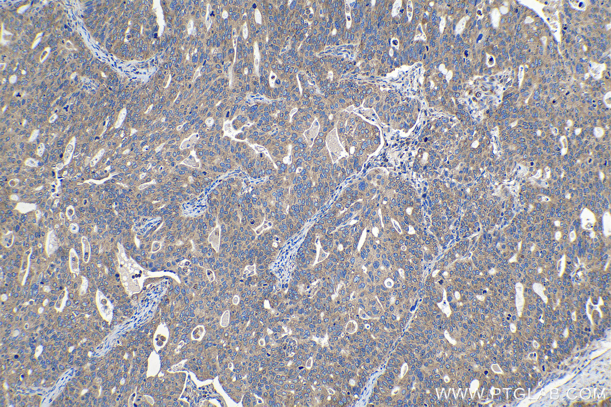 Immunohistochemical analysis of paraffin-embedded human ovary tumor tissue slide using KHC1145 (RPLP0 IHC Kit).