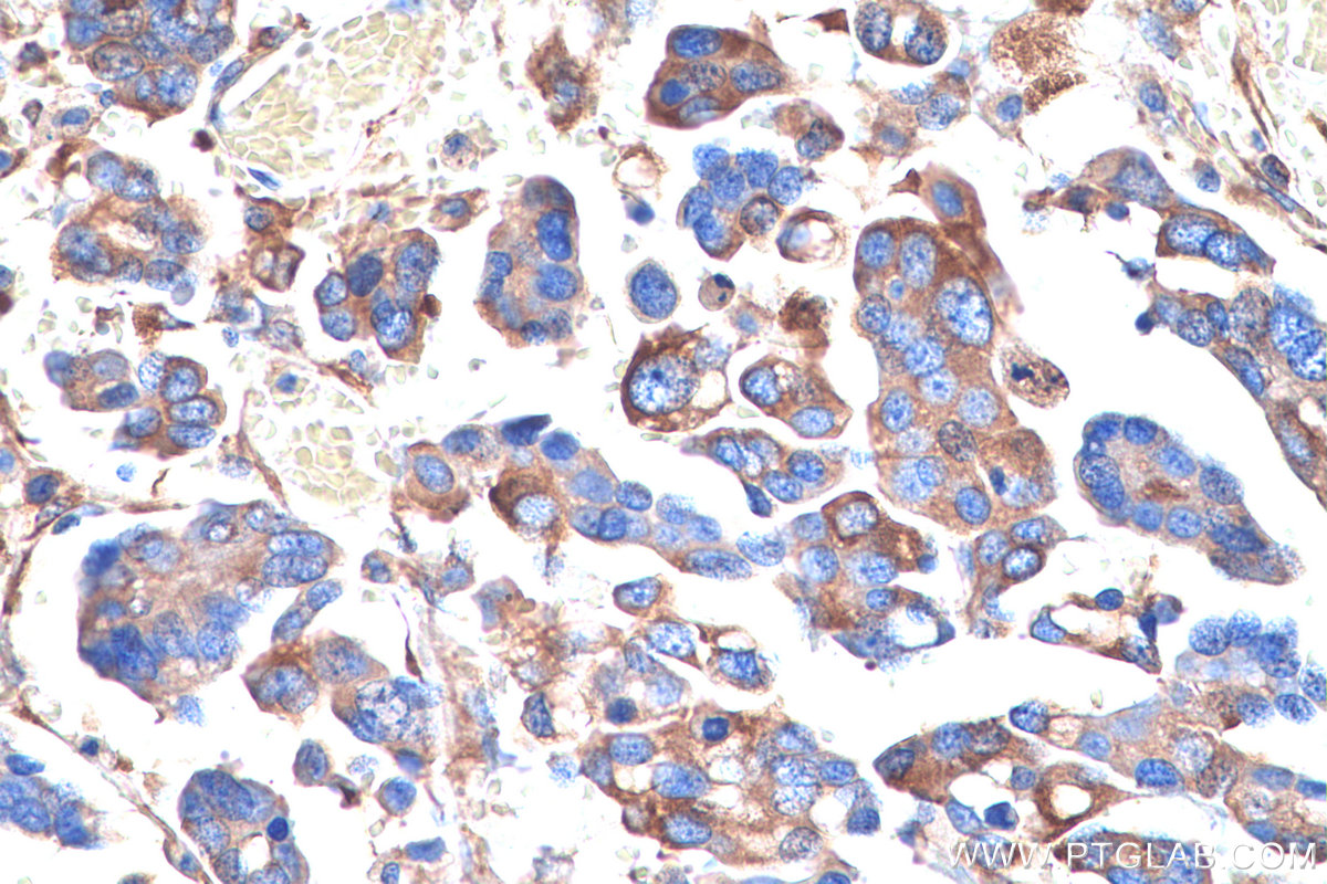 Immunohistochemical analysis of paraffin-embedded human colon cancer tissue slide using KHC0831 (RPLP1 IHC Kit).