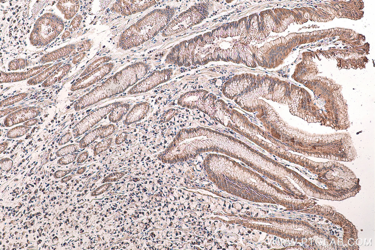 Immunohistochemical analysis of paraffin-embedded human stomach cancer tissue slide using KHC0711 (RPN2 IHC Kit).