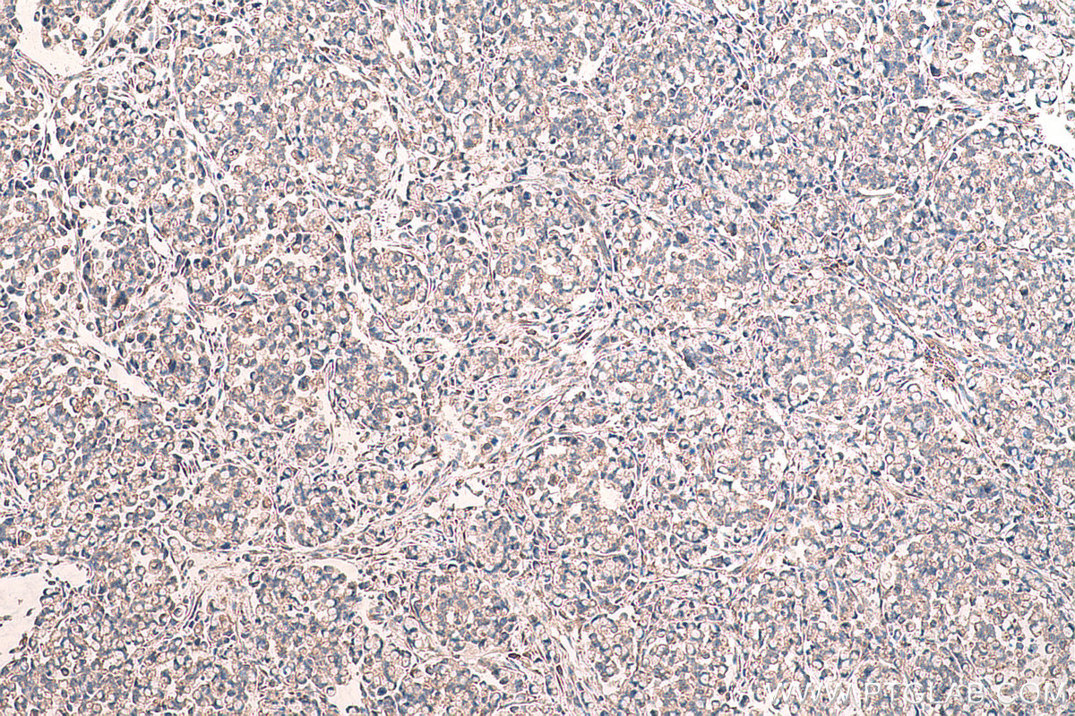 Immunohistochemical analysis of paraffin-embedded human colon cancer tissue slide using KHC0711 (RPN2 IHC Kit).