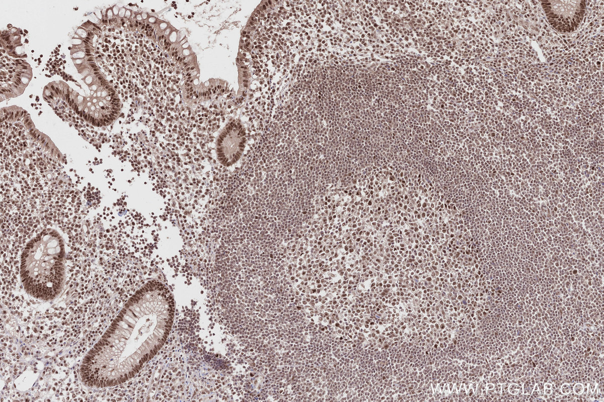 Immunohistochemical analysis of paraffin-embedded human appendicitis tissue slide using KHC2812 (RPRD1A/P15RS IHC Kit).