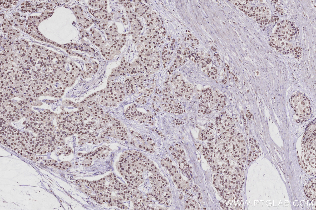 Immunohistochemical analysis of paraffin-embedded human stomach cancer tissue slide using KHC2941 (RPRD1B IHC Kit).