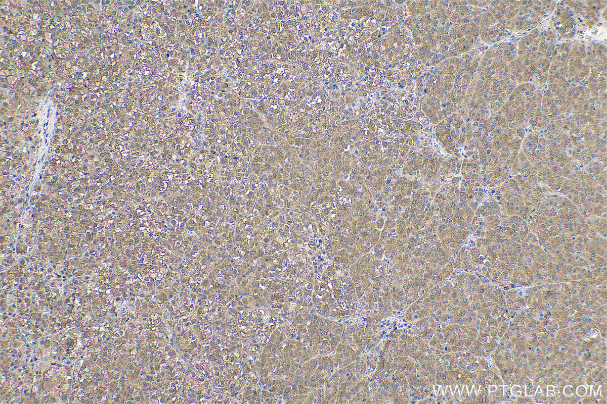 Immunohistochemical analysis of paraffin-embedded human liver cancer tissue slide using KHC0595 (RPS14 IHC Kit).