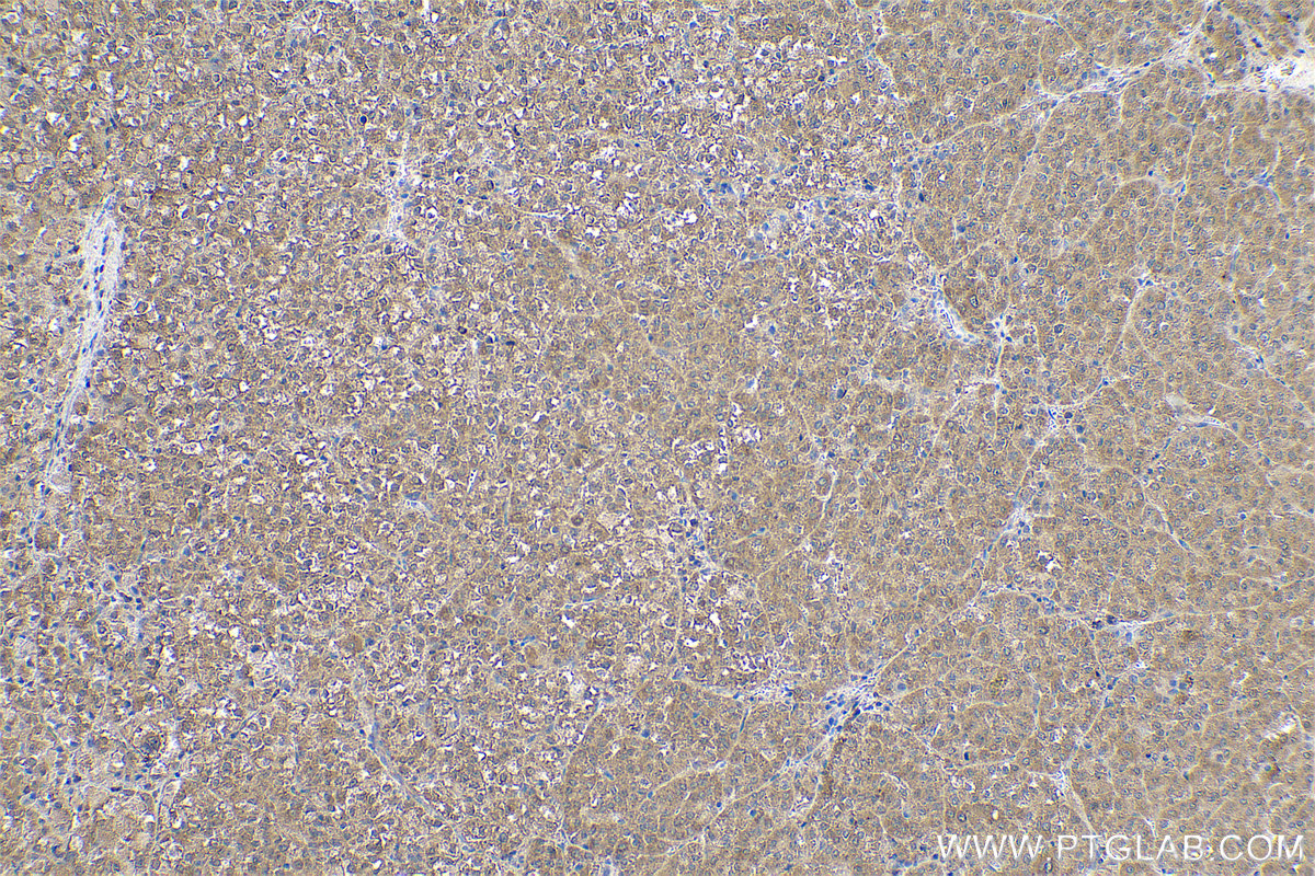 Immunohistochemical analysis of paraffin-embedded human liver cancer tissue slide using KHC0595 (RPS14 IHC Kit).