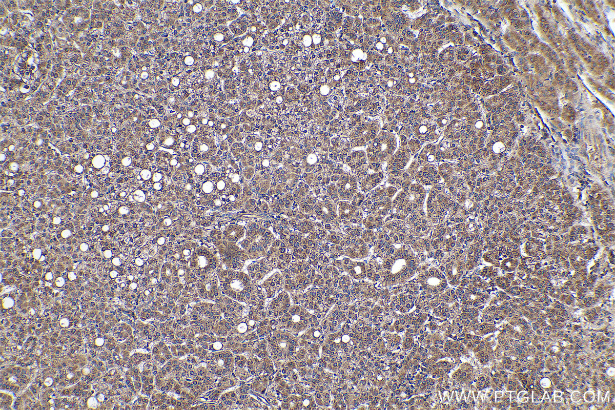 Immunohistochemical analysis of paraffin-embedded human liver cancer tissue slide using KHC0930 (RPS15 IHC Kit).