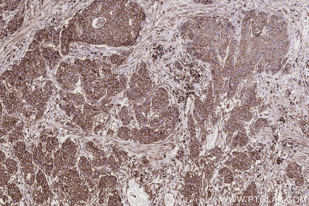 Immunohistochemical analysis of paraffin-embedded human stomach cancer tissue slide using KHC3243 (RPS23 IHC Kit). Immunohistochemical analysis of paraffin-embedded human stomach cancer tissue slide using KHC3243 (RPS23 IHC Kit).