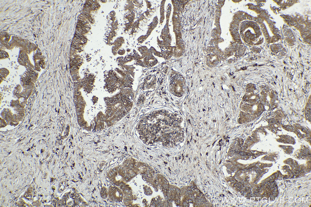 Immunohistochemical analysis of paraffin-embedded human pancreas cancer tissue slide using KHC1560 (RPS3 IHC Kit).
