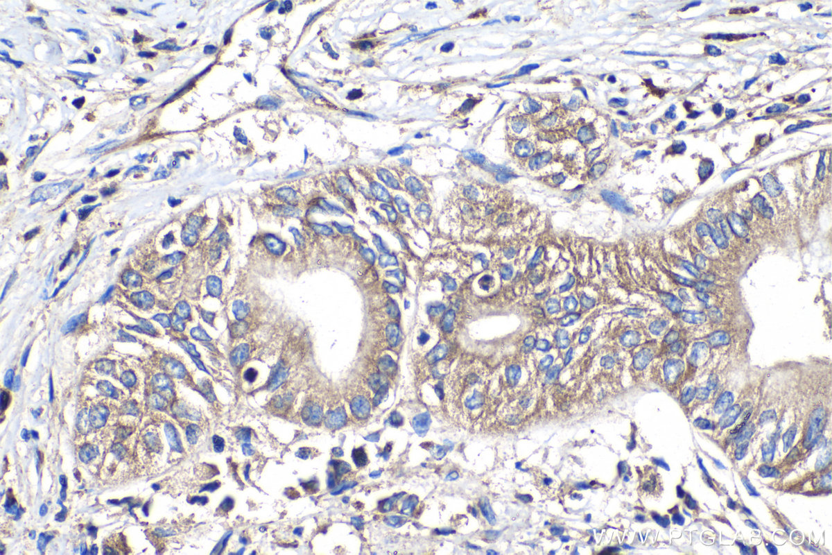 Immunohistochemical analysis of paraffin-embedded human pancreas cancer tissue slide using KHC1409 (RPS4X IHC Kit).