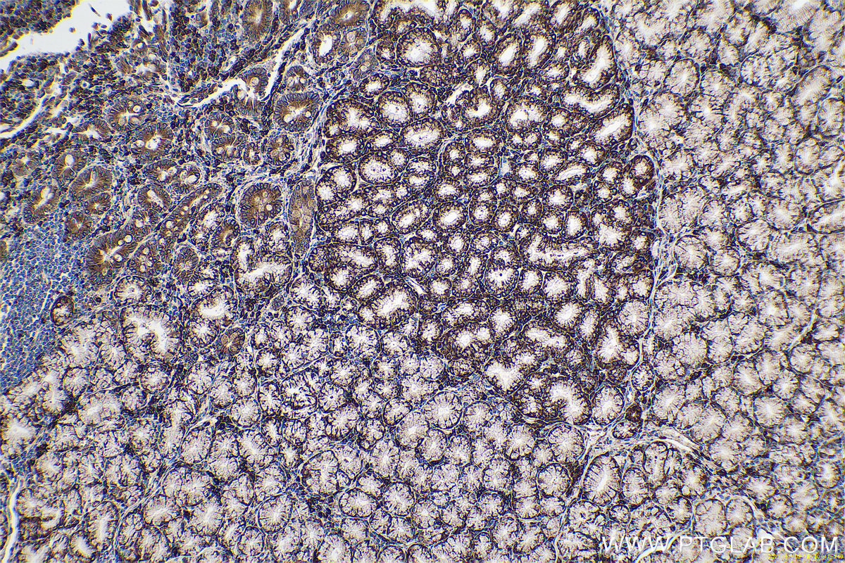 Immunohistochemical analysis of paraffin-embedded human stomach cancer tissue slide using KHC0662 (RRBP1 IHC Kit).