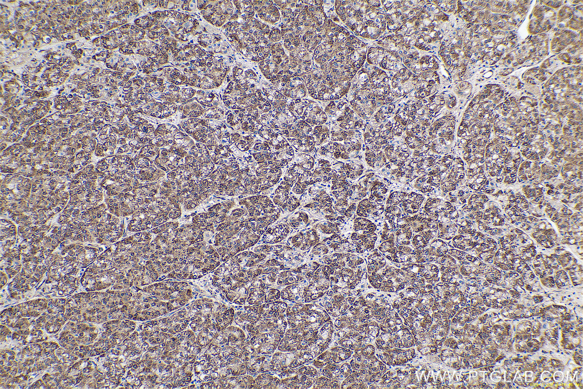 Immunohistochemical analysis of paraffin-embedded human liver cancer tissue slide using KHC0662 (RRBP1 IHC Kit).