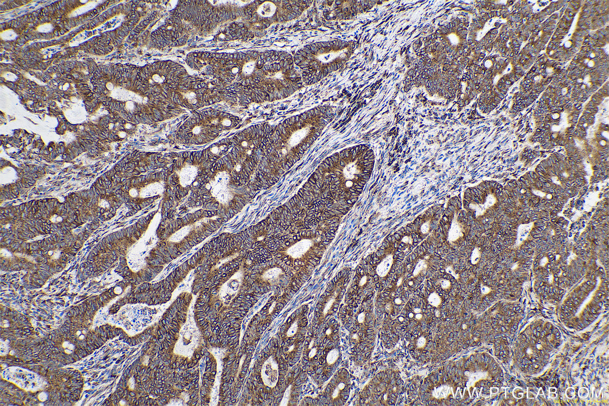 Immunohistochemical analysis of paraffin-embedded human colon cancer tissue slide using KHC0662 (RRBP1 IHC Kit).