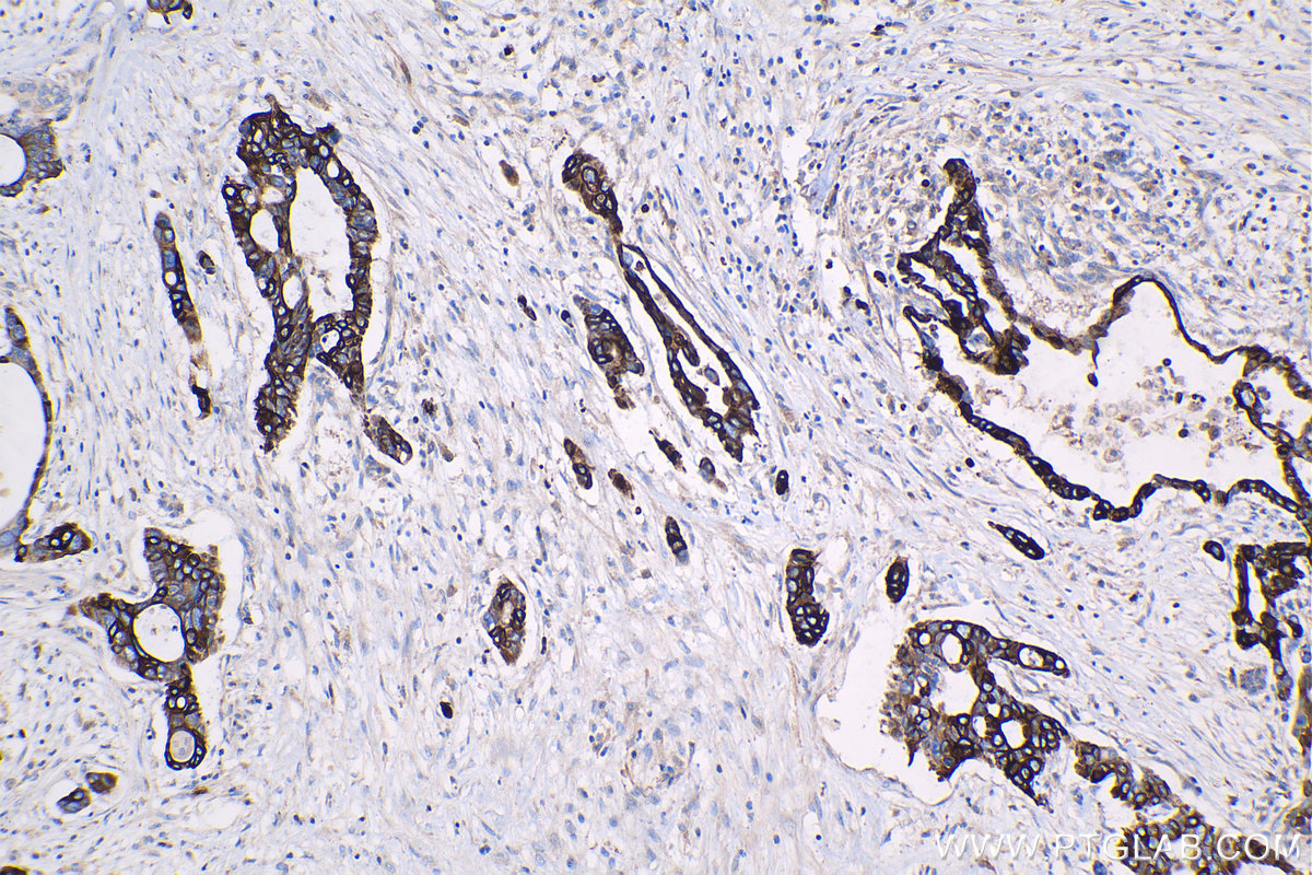 Immunohistochemical analysis of paraffin-embedded human pancreas cancer tissue slide using KHC1330 (RRM1 IHC Kit).