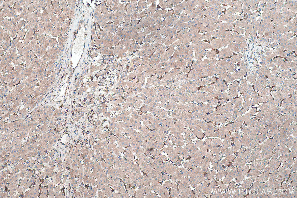 Immunohistochemical analysis of paraffin-embedded human liver cancer tissue slide using KHC0455 (RSU1 IHC Kit).