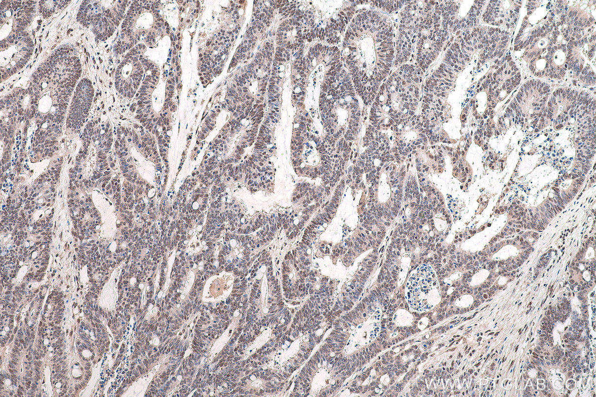 Immunohistochemical analysis of paraffin-embedded human colon cancer tissue slide using KHC0860 (RTCB IHC Kit).