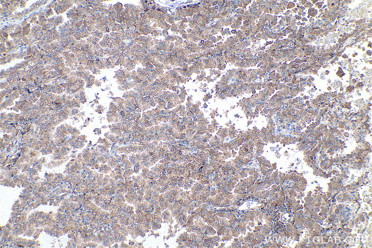 Immunohistochemical analysis of paraffin-embedded human lung cancer tissue slide using KHC0860 (RTCB IHC Kit).