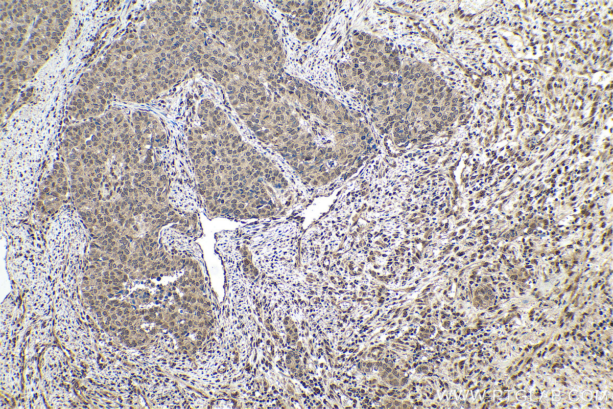 Immunohistochemical analysis of paraffin-embedded human stomach cancer tissue slide using KHC0899 (RTRAF/C14orf166 IHC Kit).