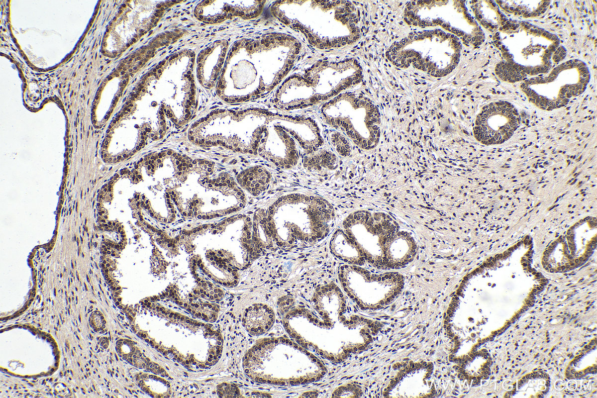 Immunohistochemical analysis of paraffin-embedded human prostate cancer tissue slide using KHC0899 (RTRAF/C14orf166 IHC Kit).