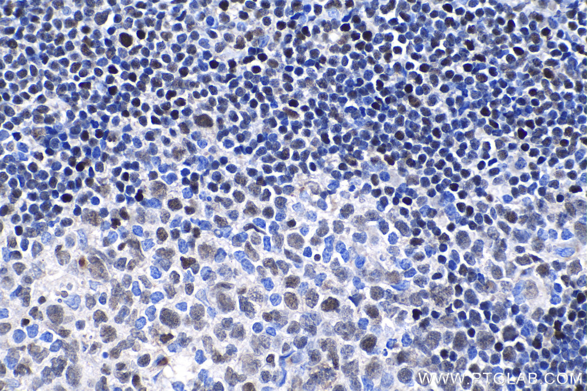 Immunohistochemical analysis of paraffin-embedded human tonsillitis tissue slide using KHC1084 (RUNX3 IHC Kit).