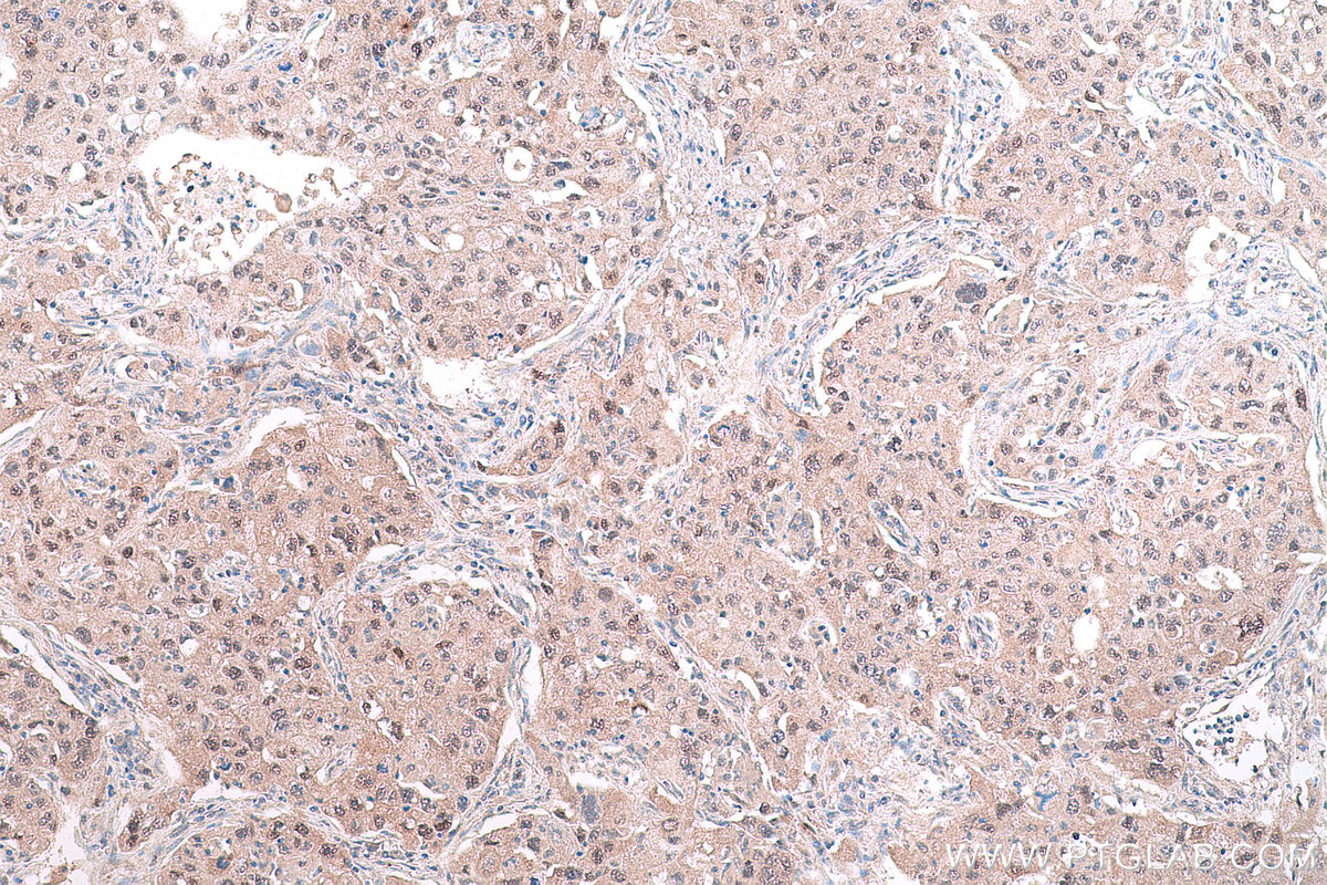 Immunohistochemical analysis of paraffin-embedded human lung cancer tissue slide using KHC0828 (RUVBL1 IHC Kit).