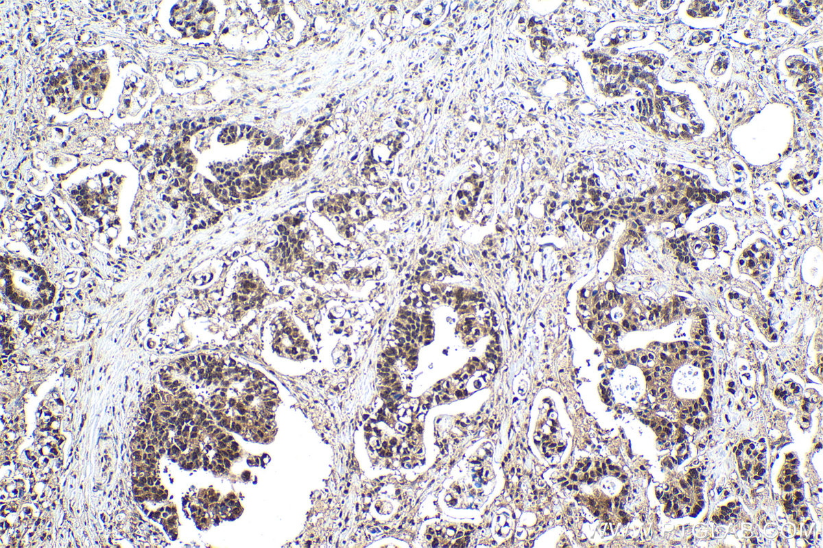 Immunohistochemical analysis of paraffin-embedded human stomach cancer tissue slide using KHC1603 (RXRA IHC Kit).