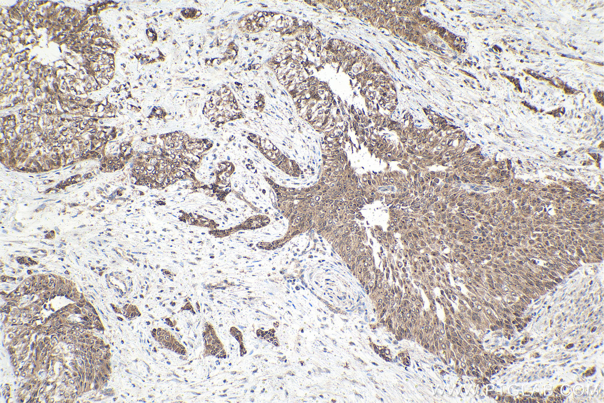 Immunohistochemical analysis of paraffin-embedded human urothelial carcinoma tissue slide using KHC1611 (RXRG IHC Kit).