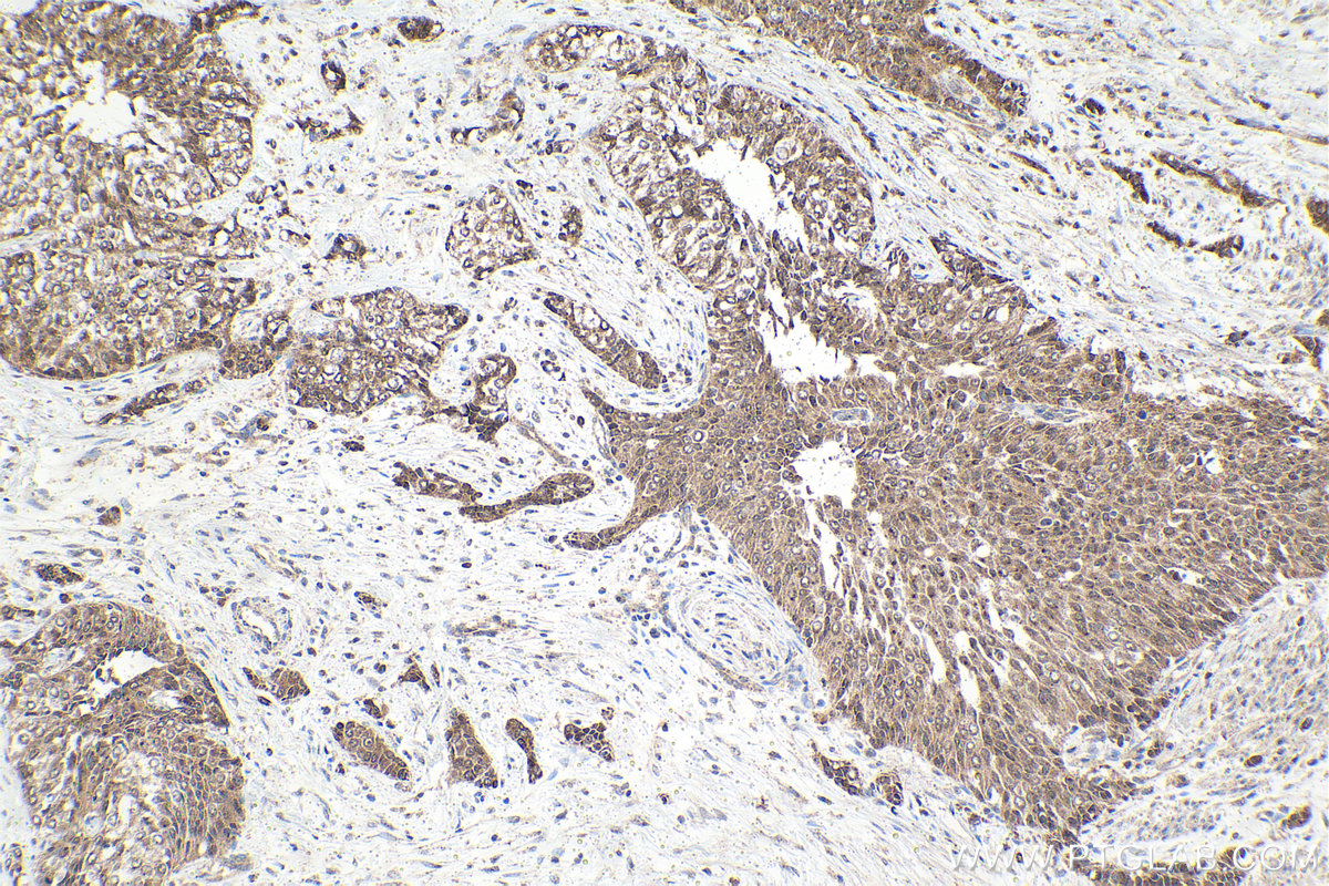 Immunohistochemical analysis of paraffin-embedded human urothelial carcinoma tissue slide using KHC1611 (RXRG IHC Kit).