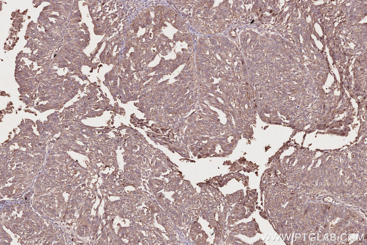 Immunohistochemical analysis of paraffin-embedded human ovary cancer tissue slide using KHC2666 (Raptor IHC Kit).