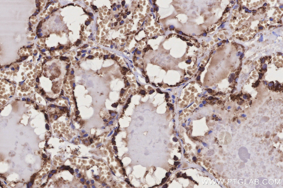 Immunohistochemical analysis of paraffin-embedded human thyroid cancer tissue slide using KHC3169 (Ribophorin I IHC Kit).