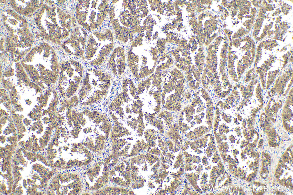 Immunohistochemical analysis of paraffin-embedded human lung cancer tissue slide using KHC0550 (S100A11 IHC Kit).