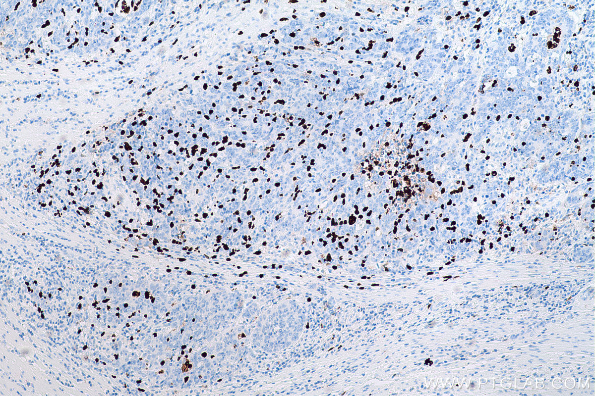 Immunohistochemical analysis of paraffin-embedded human colon cancer tissue slide using KHC0581 (S100A12 IHC Kit).