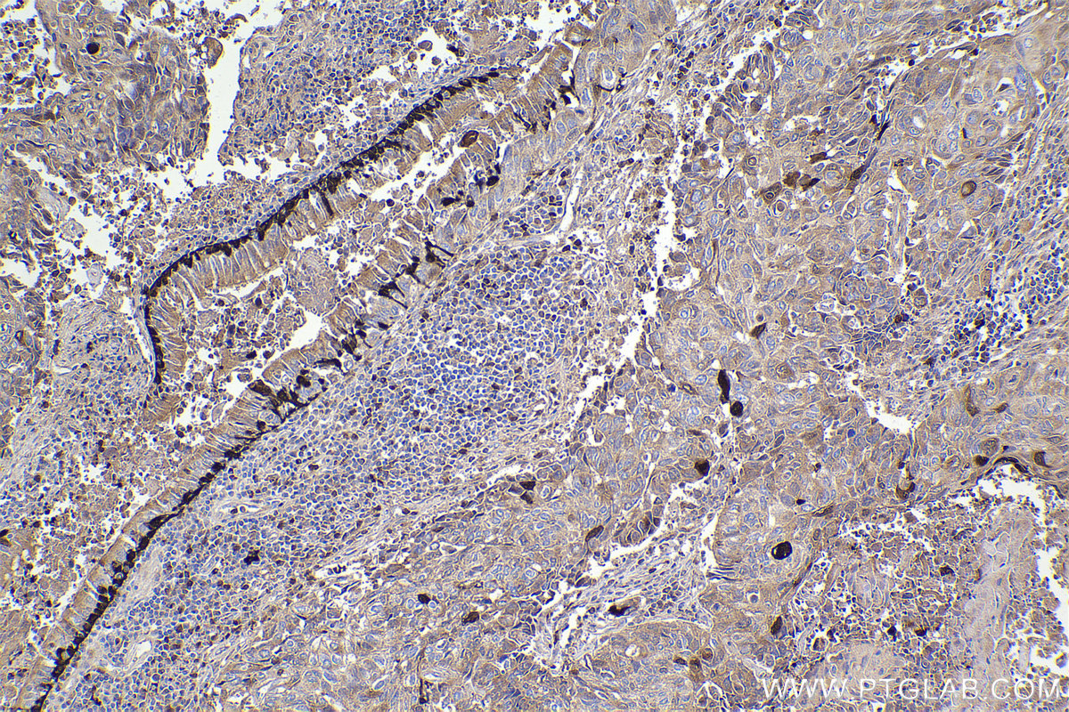 Immunohistochemical analysis of paraffin-embedded human lung cancer tissue slide using KHC2219 (S100A2 IHC Kit).