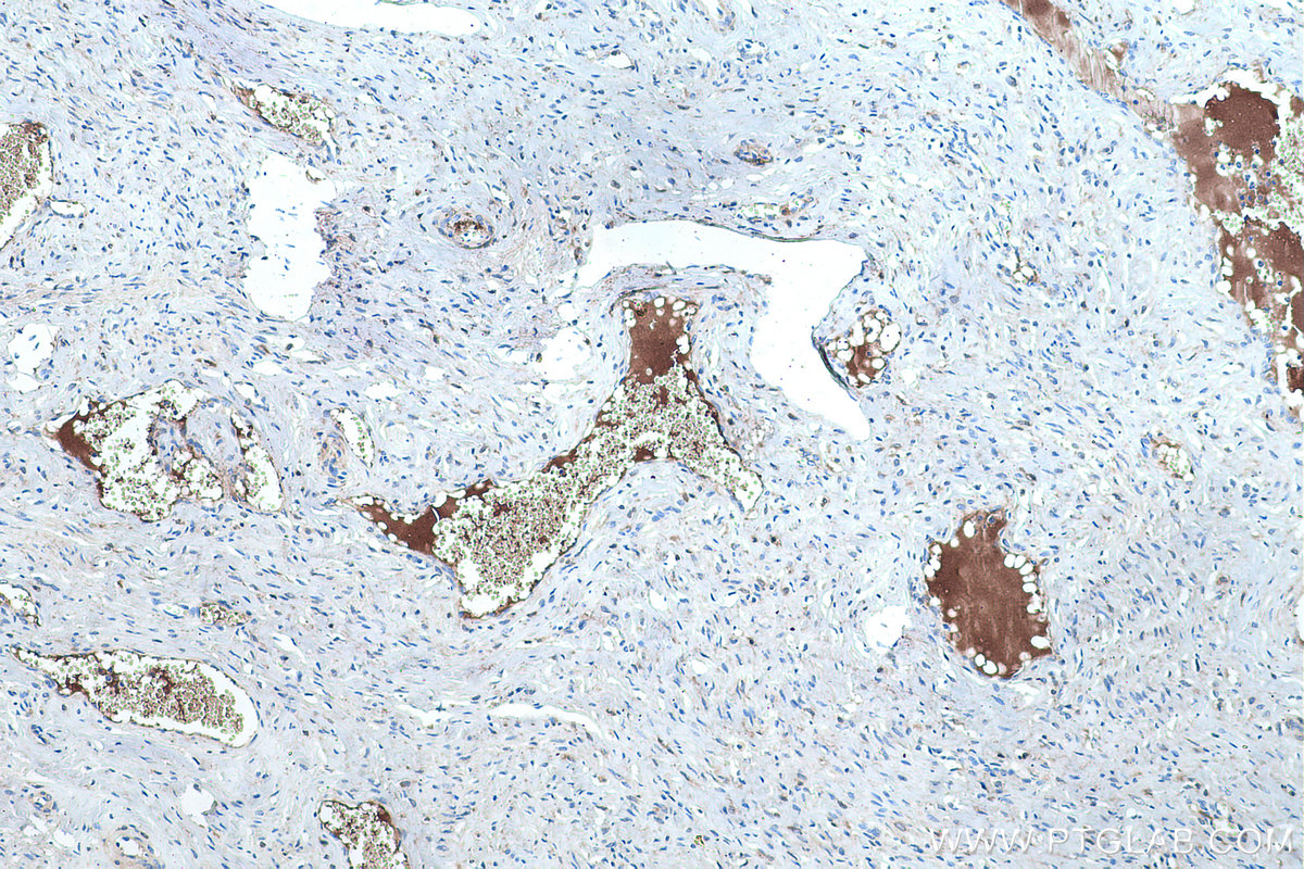 Immunohistochemical analysis of paraffin-embedded human cervical cancer tissue slide using KHC0456 (SAA4 IHC Kit).