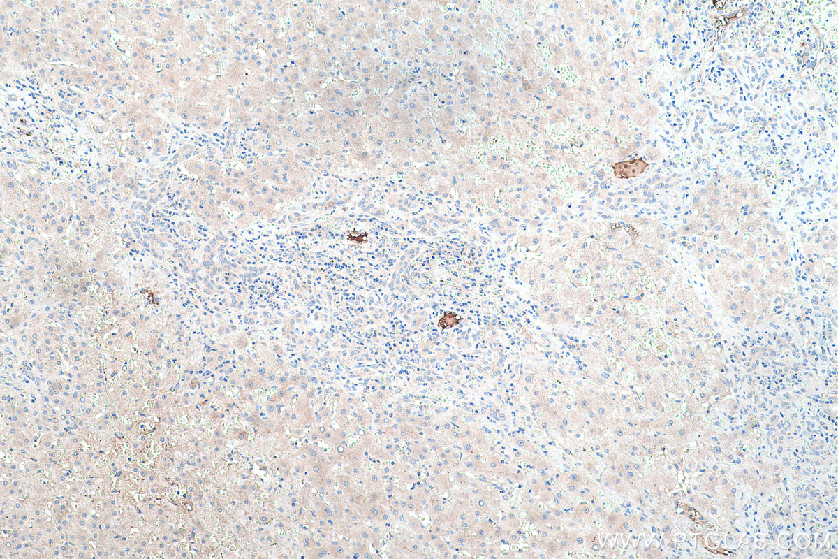 Immunohistochemical analysis of paraffin-embedded human liver cancer tissue slide using KHC0456 (SAA4 IHC Kit).