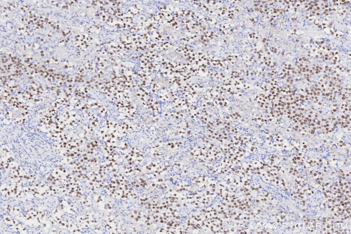 Immunohistochemical analysis of paraffin-embedded human seminoma tissue slide using KHC3312 (SALL4 IHC Kit).