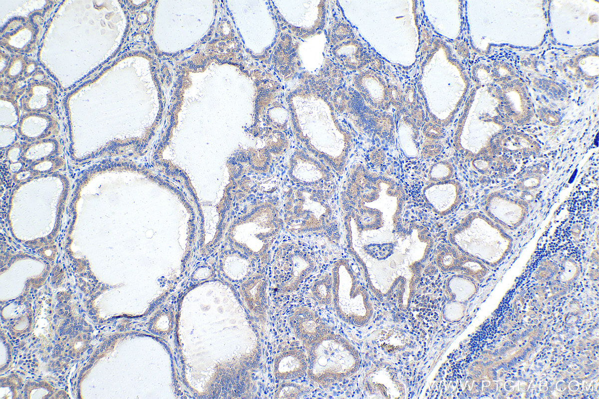 Immunohistochemical analysis of paraffin-embedded human thyroid cancer tissue slide using KHC1776 (SAMD4B IHC Kit).